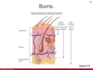 © 2019 McGraw-Hill Education
56
Burns2
Figure 5.9
 