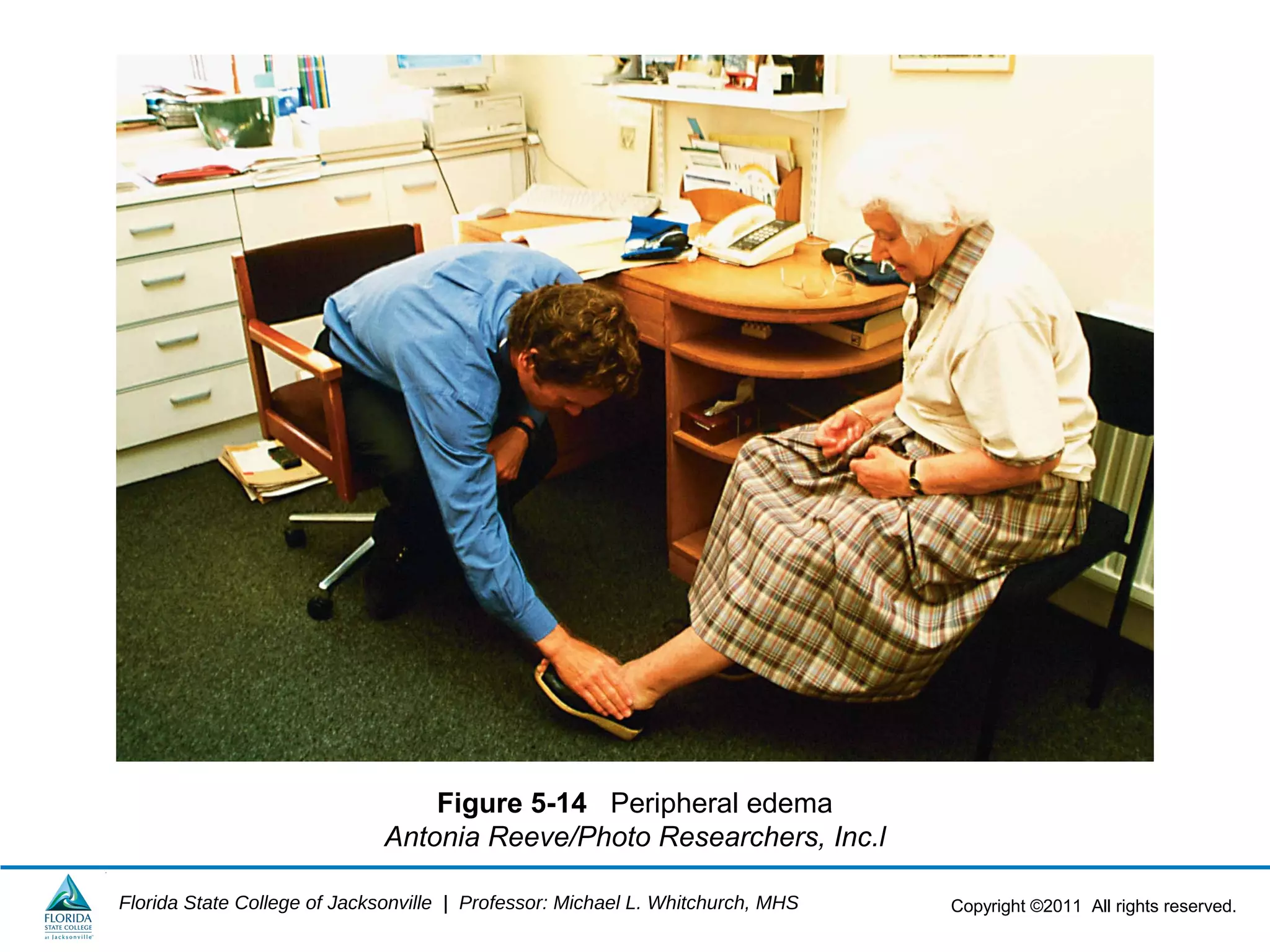 Copyright ©2011 All rights reserved.Florida State College of Jacksonville | Professor: Michael L. Whitchurch, MHS
Figure 5-14 Peripheral edema
Antonia Reeve/Photo Researchers, Inc.l
 