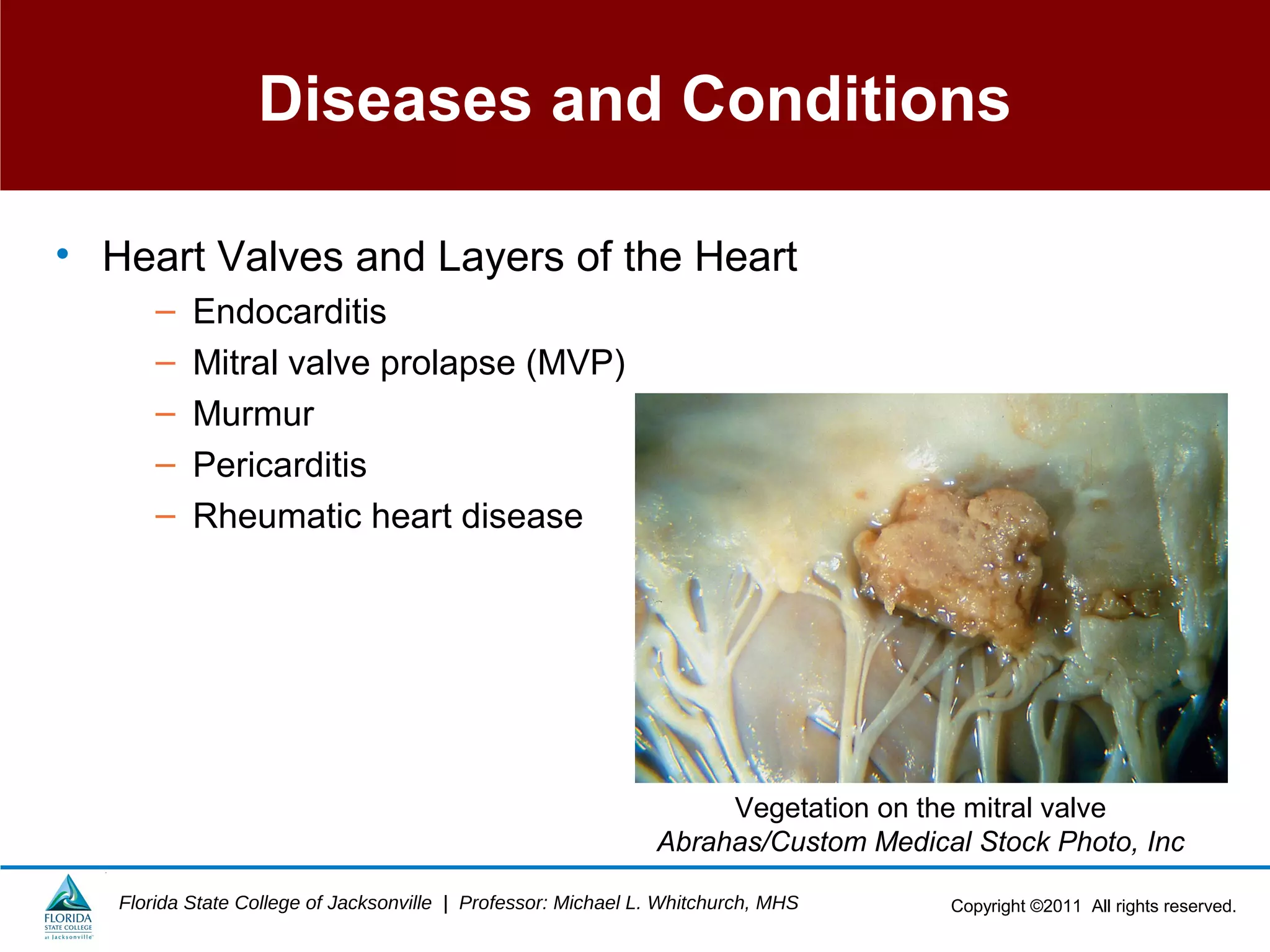 Copyright ©2011 All rights reserved.Florida State College of Jacksonville | Professor: Michael L. Whitchurch, MHS
Diseases and Conditions
• Heart Valves and Layers of the Heart
– Endocarditis
– Mitral valve prolapse (MVP)
– Murmur
– Pericarditis
– Rheumatic heart disease
Vegetation on the mitral valve
Abrahas/Custom Medical Stock Photo, Inc
 