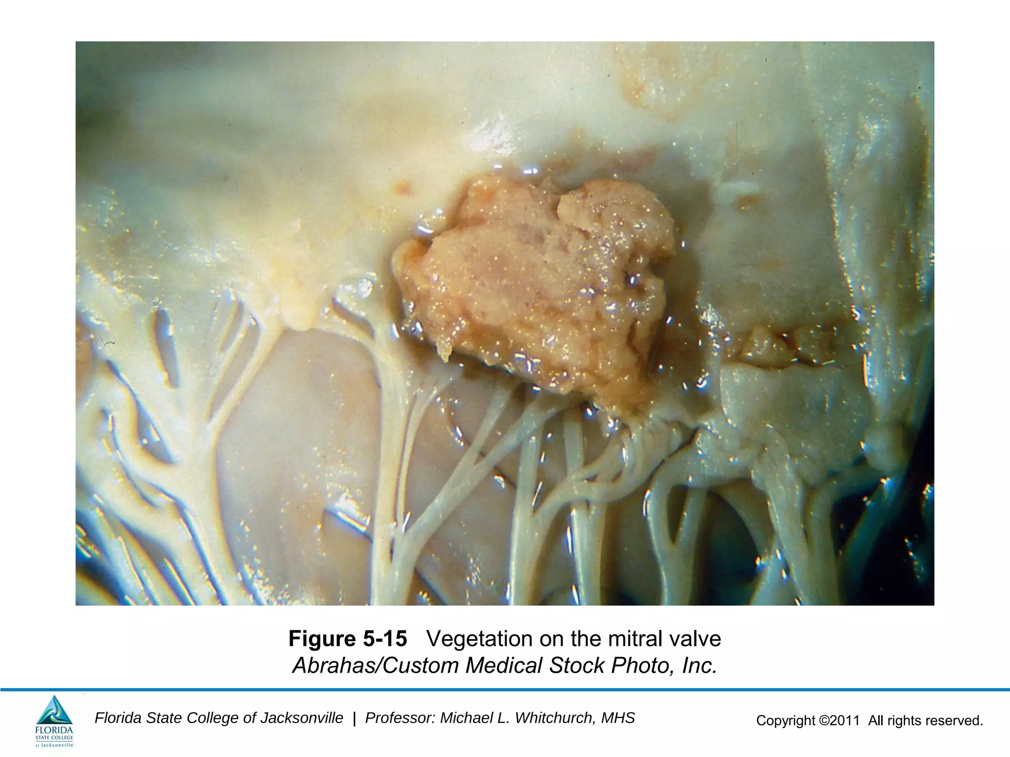 Copyright ©2011 All rights reserved.Florida State College of Jacksonville | Professor: Michael L. Whitchurch, MHS
Figure 5-15 Vegetation on the mitral valve
Abrahas/Custom Medical Stock Photo, Inc.
 
