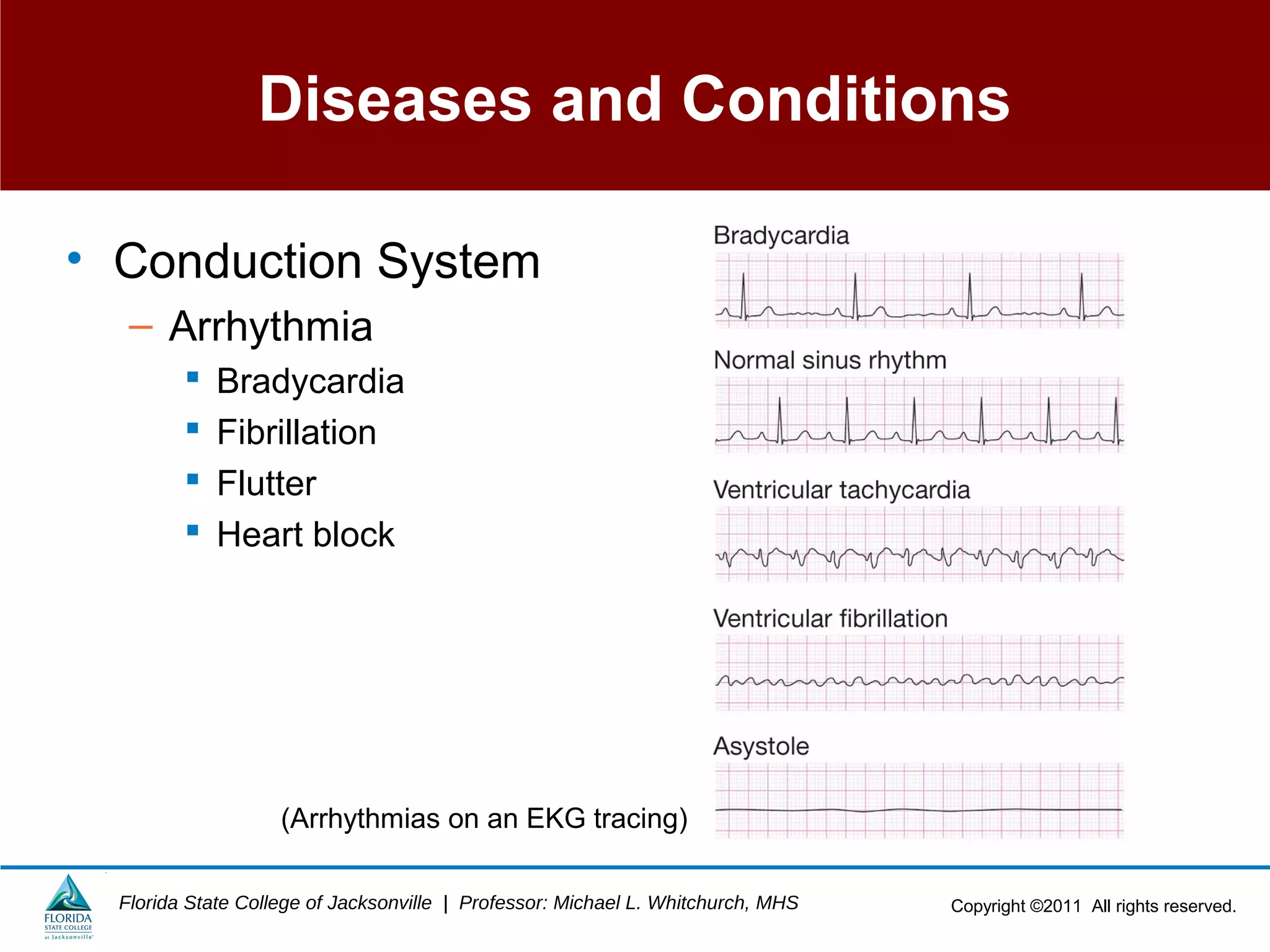 Copyright ©2011 All rights reserved.Florida State College of Jacksonville | Professor: Michael L. Whitchurch, MHS
Diseases and Conditions
• Conduction System
– Arrhythmia
 Bradycardia
 Fibrillation
 Flutter
 Heart block
(Arrhythmias on an EKG tracing)
 