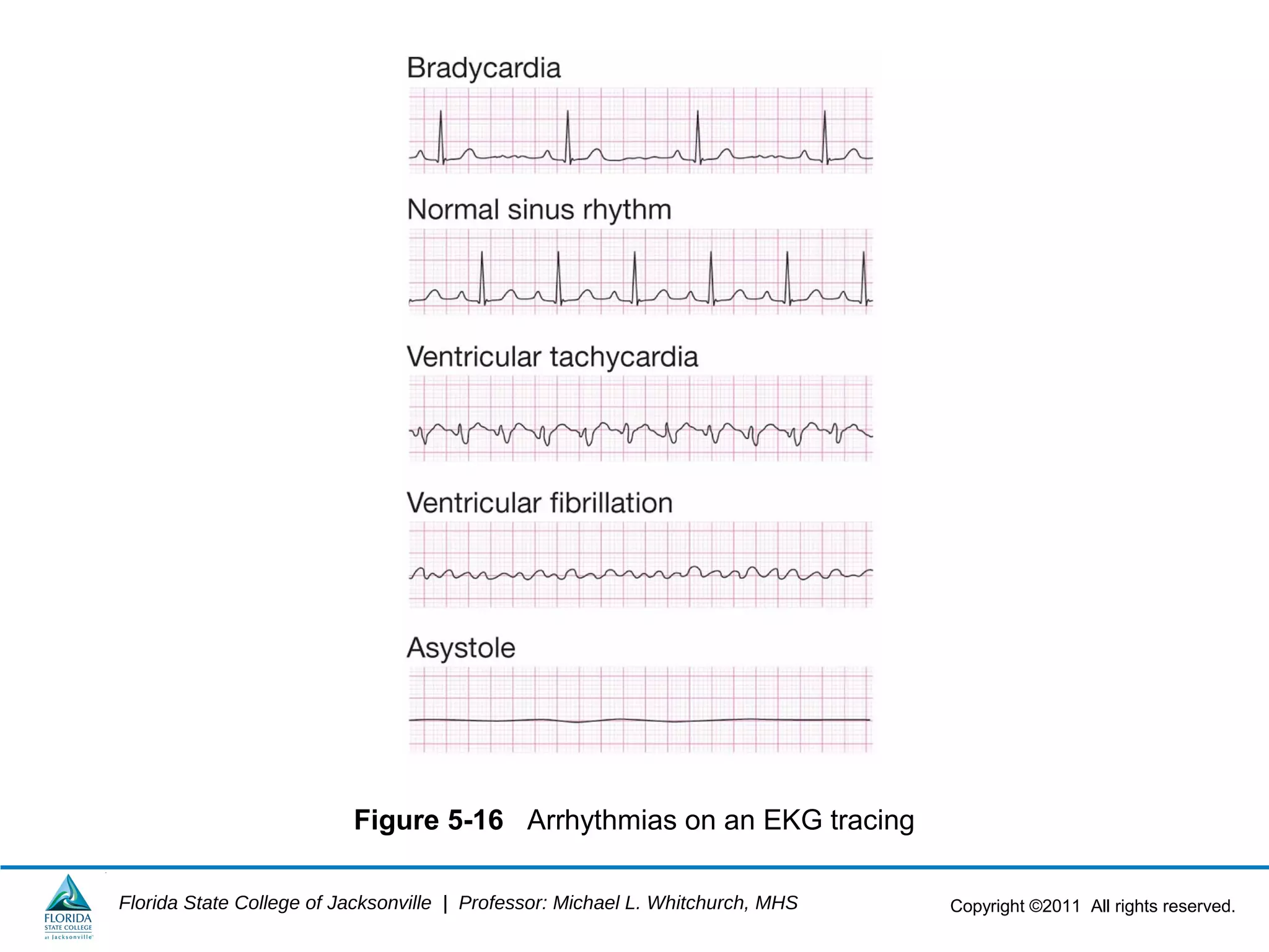 Copyright ©2011 All rights reserved.Florida State College of Jacksonville | Professor: Michael L. Whitchurch, MHS
Figure 5-16 Arrhythmias on an EKG tracing
 
