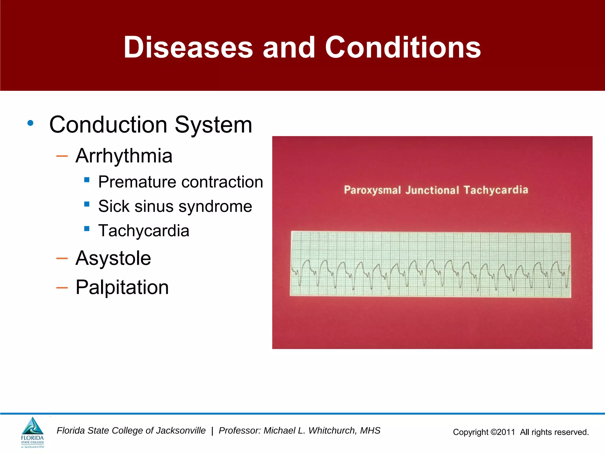 Copyright ©2011 All rights reserved.Florida State College of Jacksonville | Professor: Michael L. Whitchurch, MHS
Diseases and Conditions
• Conduction System
– Arrhythmia
 Premature contraction
 Sick sinus syndrome
 Tachycardia
– Asystole
– Palpitation
 