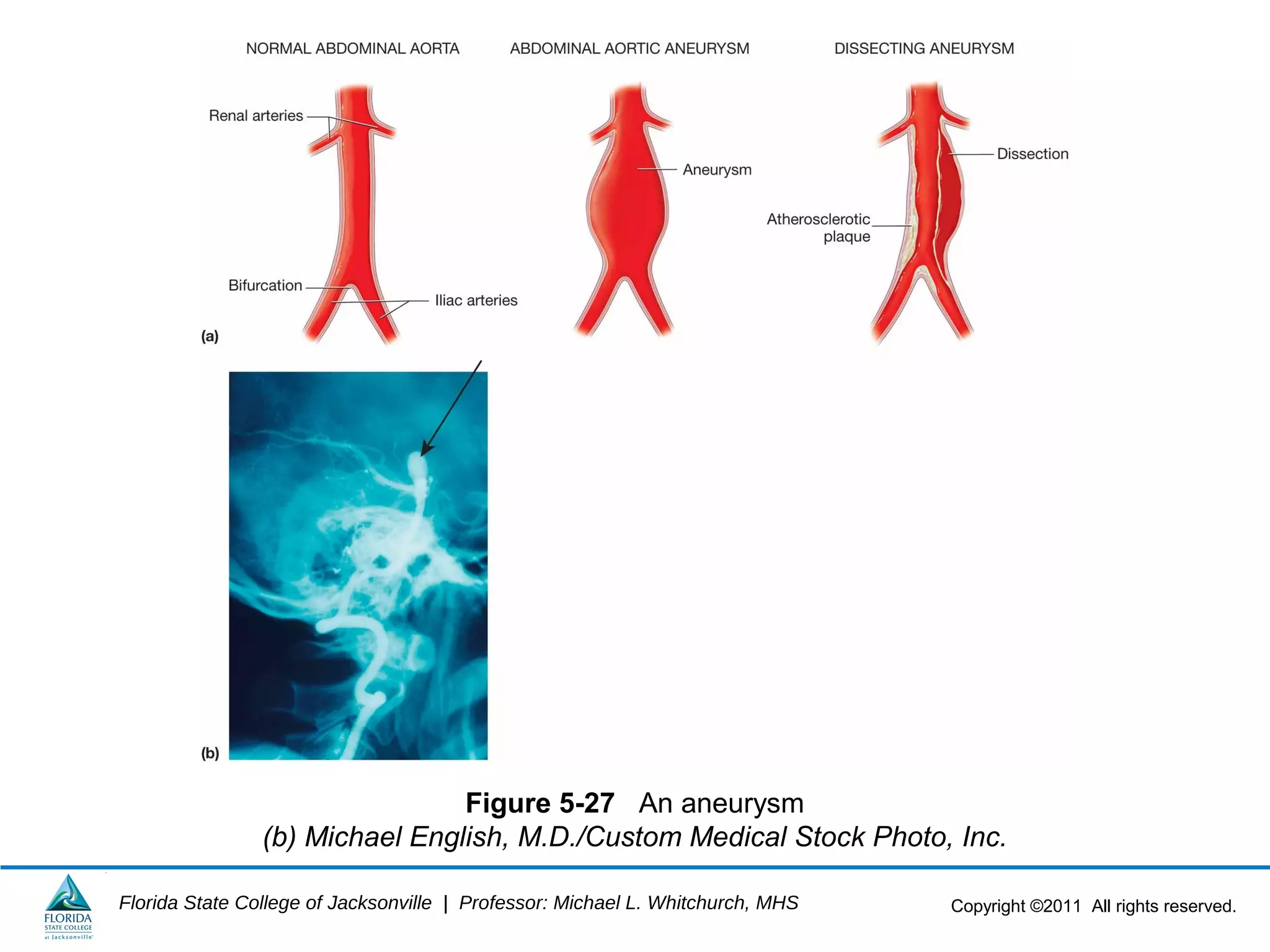 Copyright ©2011 All rights reserved.Florida State College of Jacksonville | Professor: Michael L. Whitchurch, MHS
Figure 5-27 An aneurysm
(b) Michael English, M.D./Custom Medical Stock Photo, Inc.
 