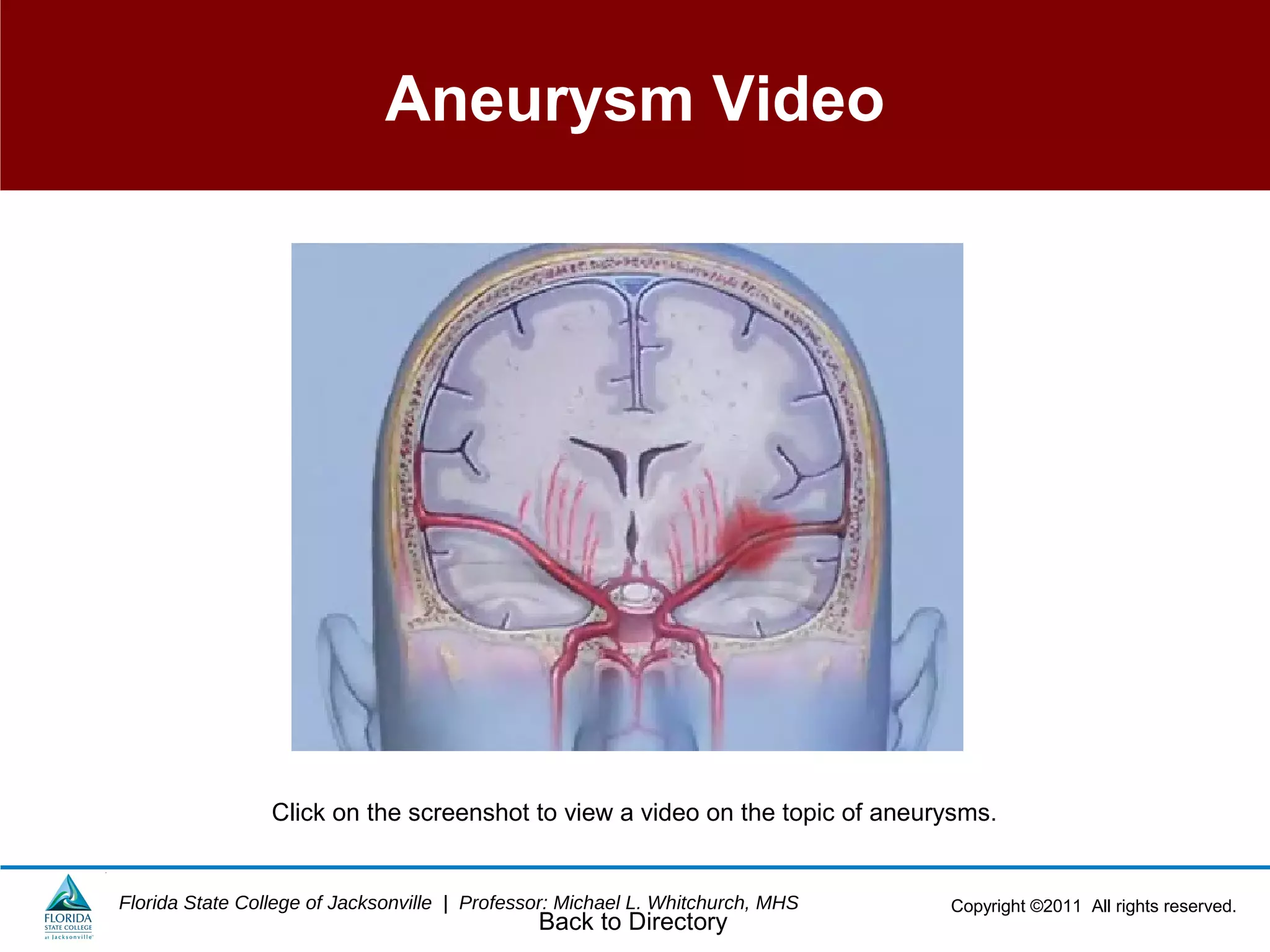 Copyright ©2011 All rights reserved.Florida State College of Jacksonville | Professor: Michael L. Whitchurch, MHS
Aneurysm Video
Click on the screenshot to view a video on the topic of aneurysms.
Back to Directory
 