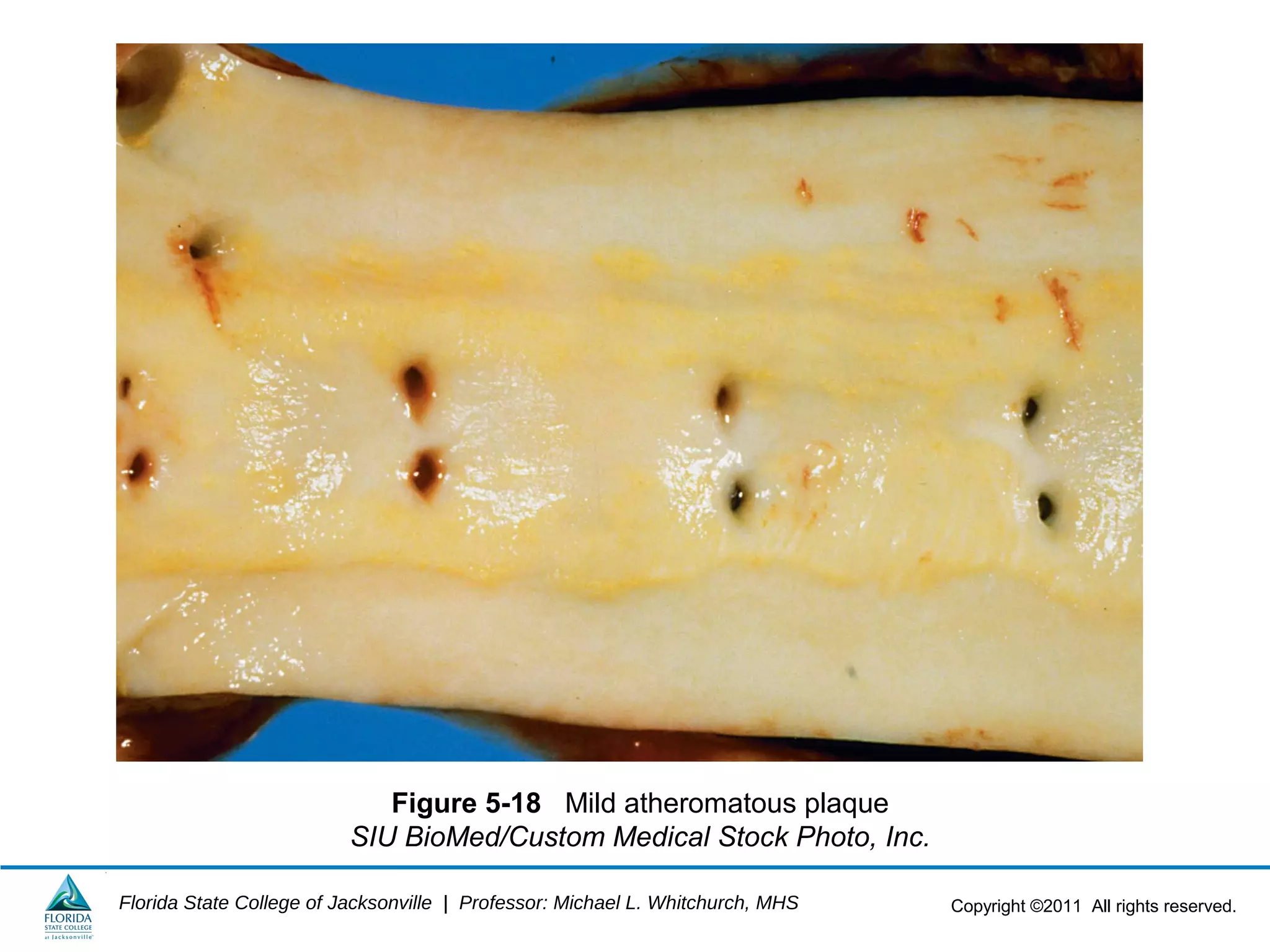 Copyright ©2011 All rights reserved.Florida State College of Jacksonville | Professor: Michael L. Whitchurch, MHS
Figure 5-18 Mild atheromatous plaque
SIU BioMed/Custom Medical Stock Photo, Inc.
 