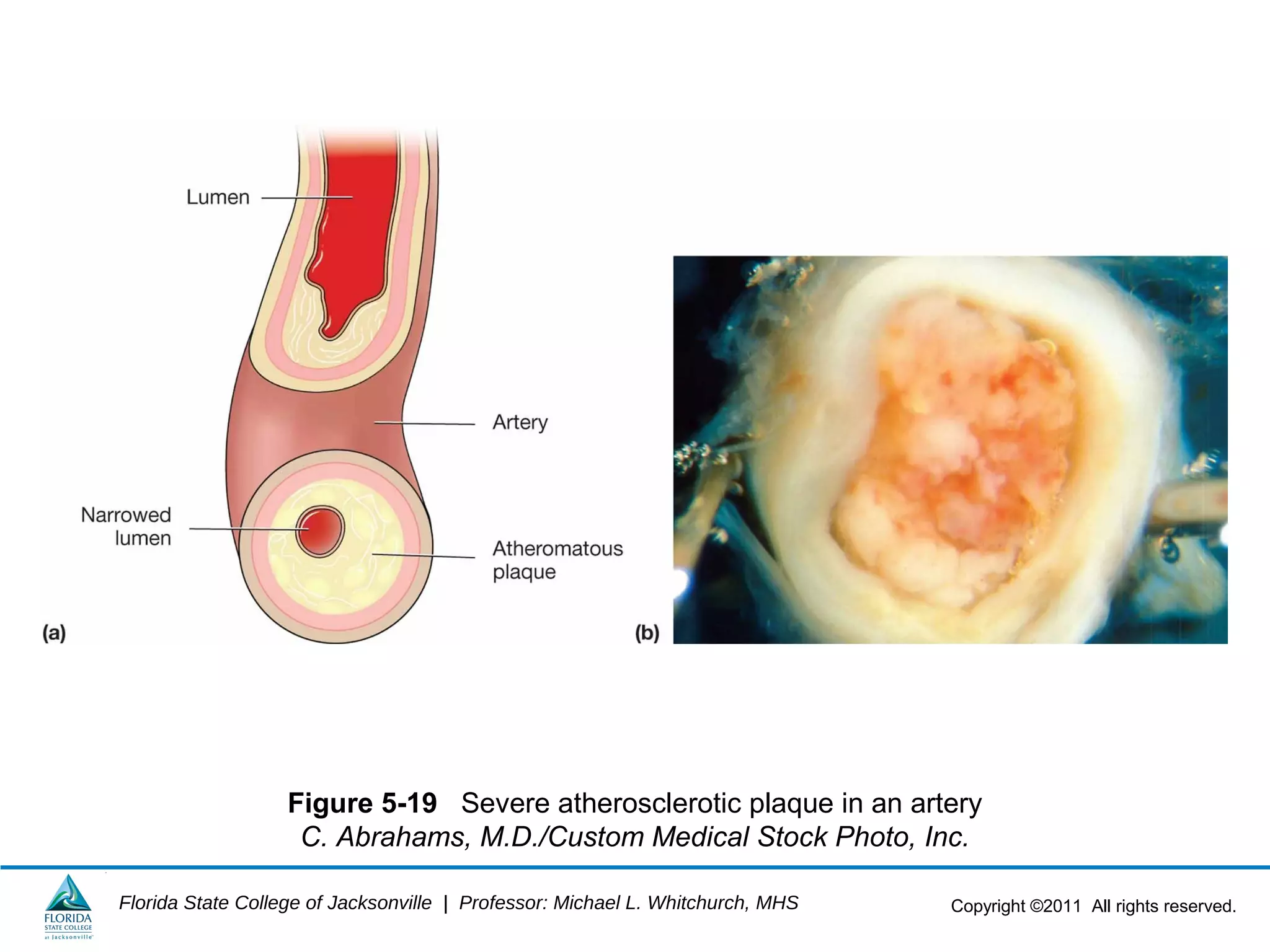 Copyright ©2011 All rights reserved.Florida State College of Jacksonville | Professor: Michael L. Whitchurch, MHS
Figure 5-19 Severe atherosclerotic plaque in an artery
C. Abrahams, M.D./Custom Medical Stock Photo, Inc.
 