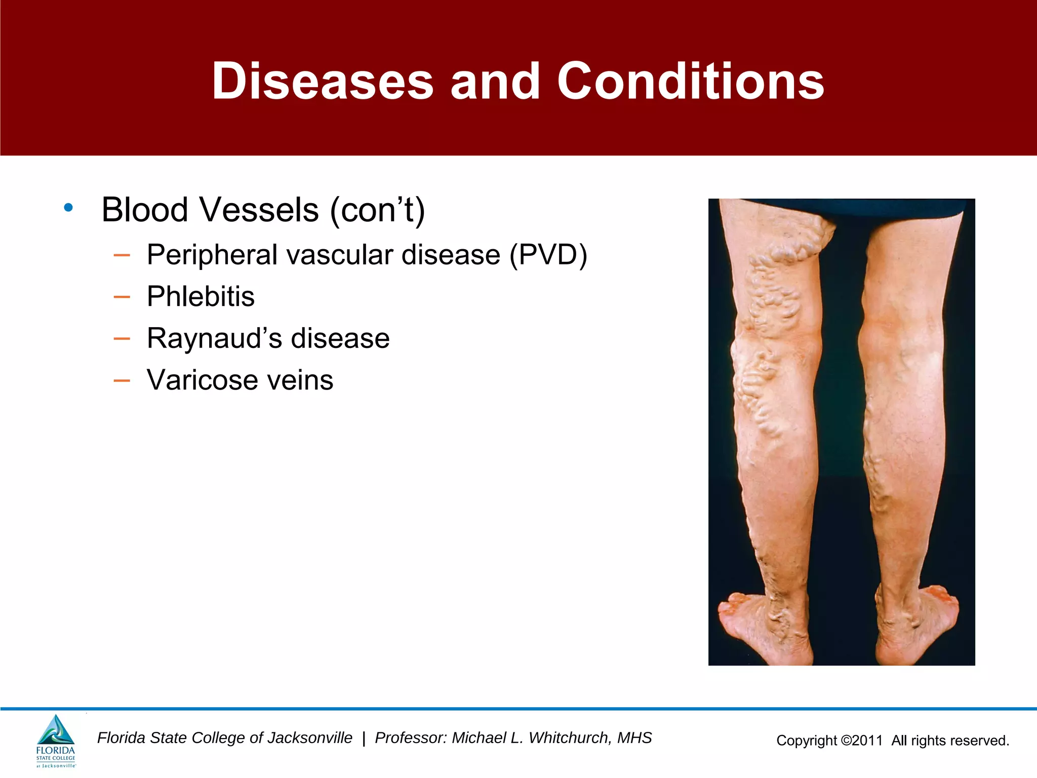 Copyright ©2011 All rights reserved.Florida State College of Jacksonville | Professor: Michael L. Whitchurch, MHS
Diseases and Conditions
• Blood Vessels (con’t)
– Peripheral vascular disease (PVD)
– Phlebitis
– Raynaud’s disease
– Varicose veins
 