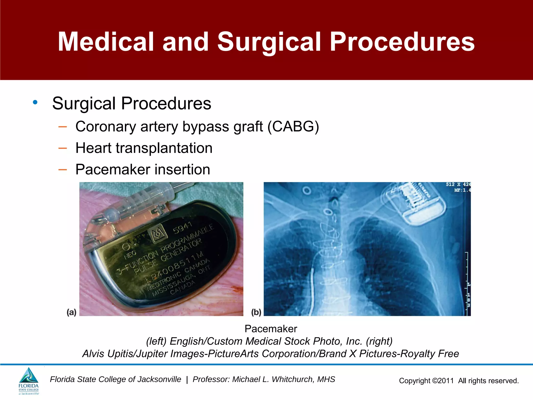 Copyright ©2011 All rights reserved.Florida State College of Jacksonville | Professor: Michael L. Whitchurch, MHS
Medical and Surgical Procedures
• Surgical Procedures
– Coronary artery bypass graft (CABG)
– Heart transplantation
– Pacemaker insertion
Pacemaker
(left) English/Custom Medical Stock Photo, Inc. (right)
Alvis Upitis/Jupiter Images-PictureArts Corporation/Brand X Pictures-Royalty Free
 