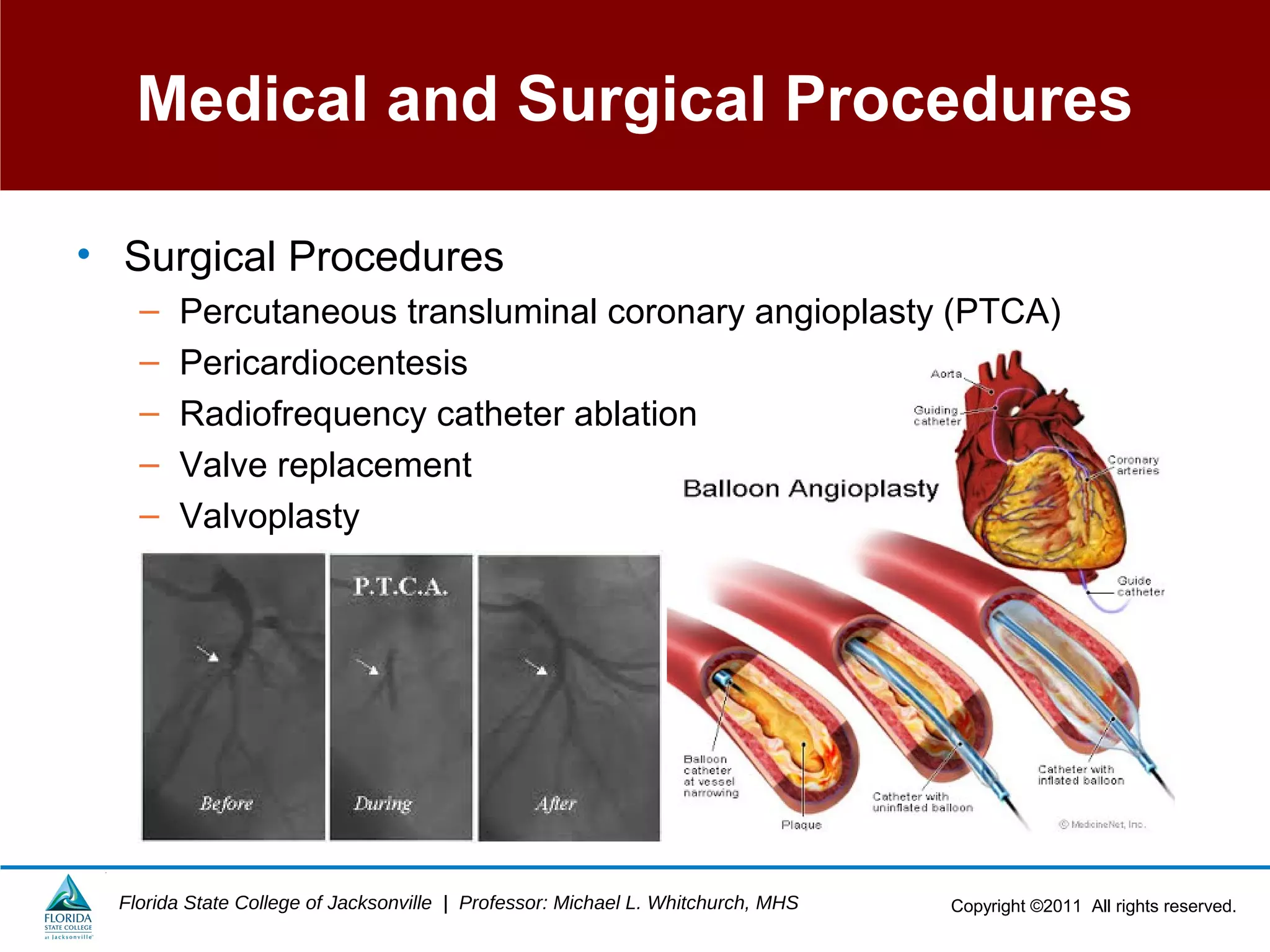 Copyright ©2011 All rights reserved.Florida State College of Jacksonville | Professor: Michael L. Whitchurch, MHS
Medical and Surgical Procedures
• Surgical Procedures
– Percutaneous transluminal coronary angioplasty (PTCA)
– Pericardiocentesis
– Radiofrequency catheter ablation
– Valve replacement
– Valvoplasty
 