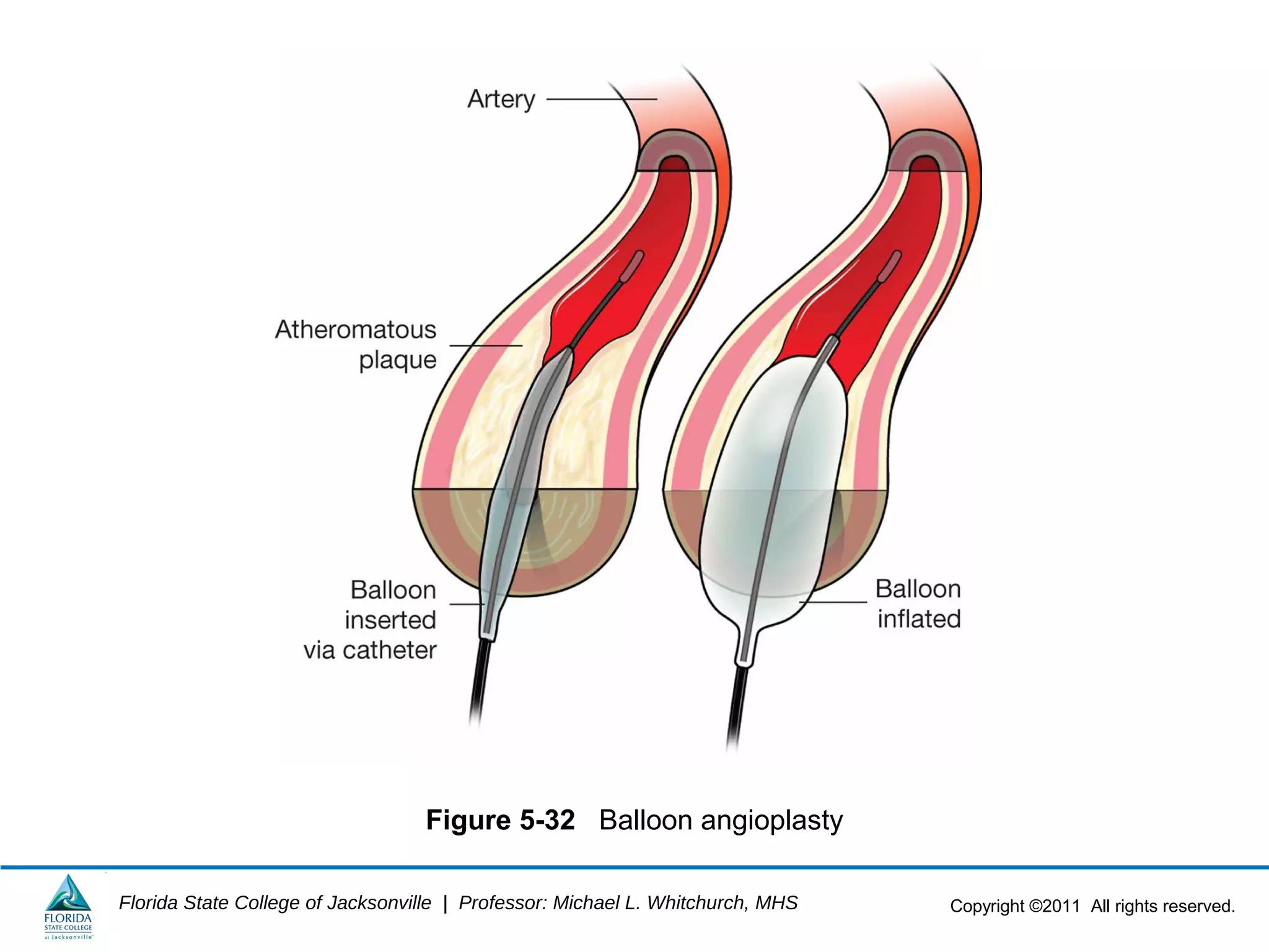 Copyright ©2011 All rights reserved.Florida State College of Jacksonville | Professor: Michael L. Whitchurch, MHS
Figure 5-32 Balloon angioplasty
 