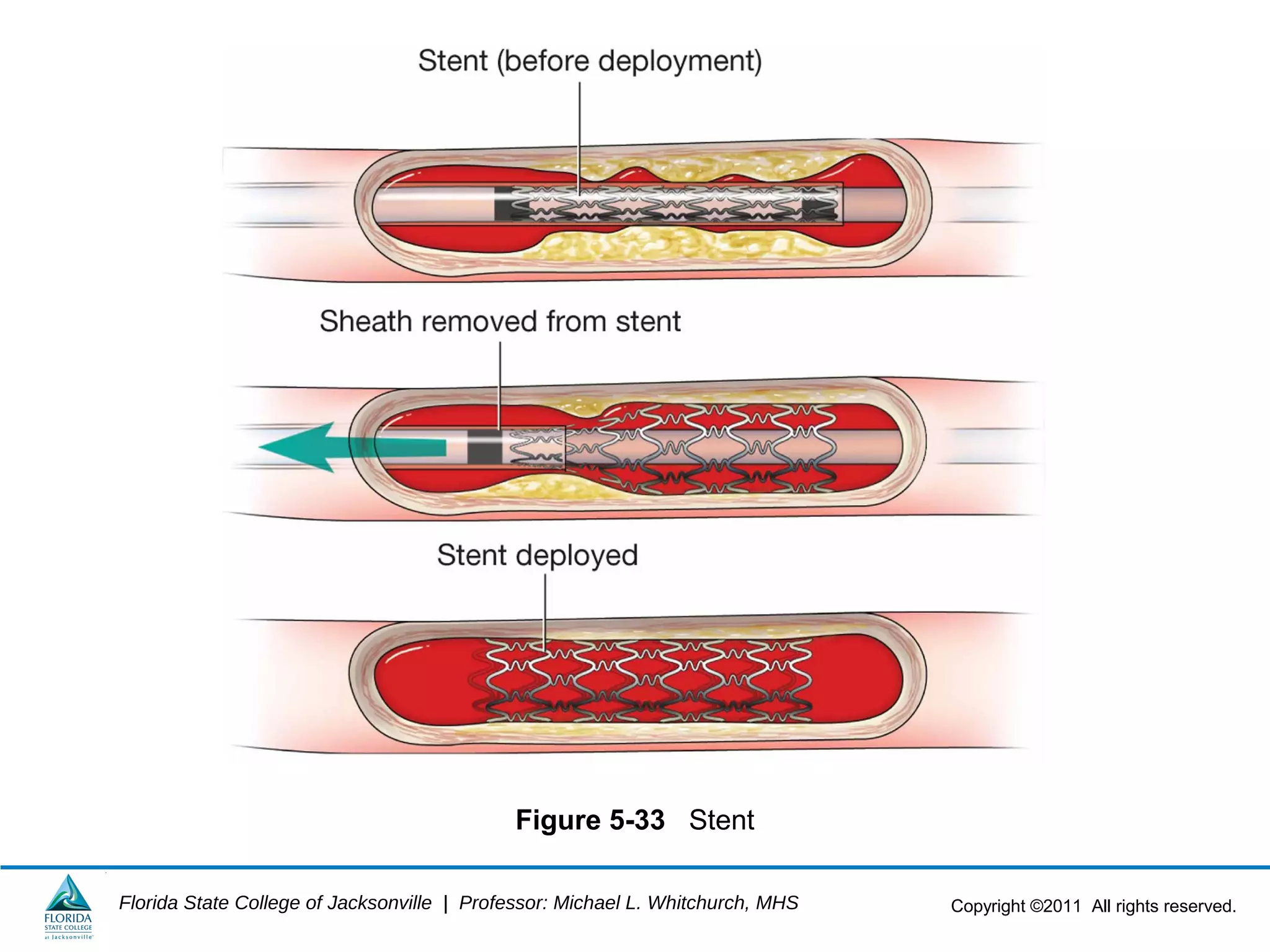 Copyright ©2011 All rights reserved.Florida State College of Jacksonville | Professor: Michael L. Whitchurch, MHS
Figure 5-33 Stent
 