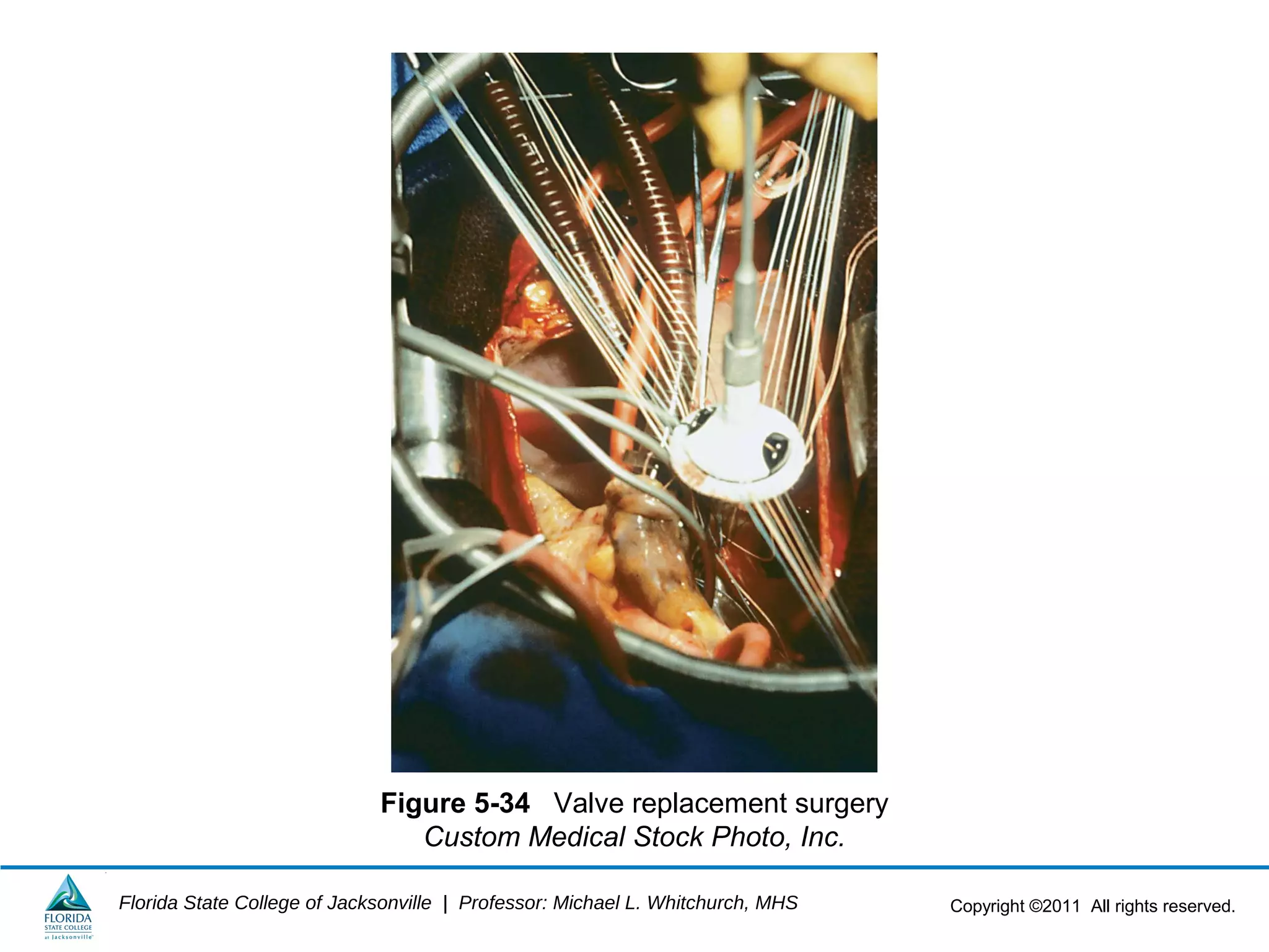 Copyright ©2011 All rights reserved.Florida State College of Jacksonville | Professor: Michael L. Whitchurch, MHS
Figure 5-34 Valve replacement surgery
Custom Medical Stock Photo, Inc.
 
