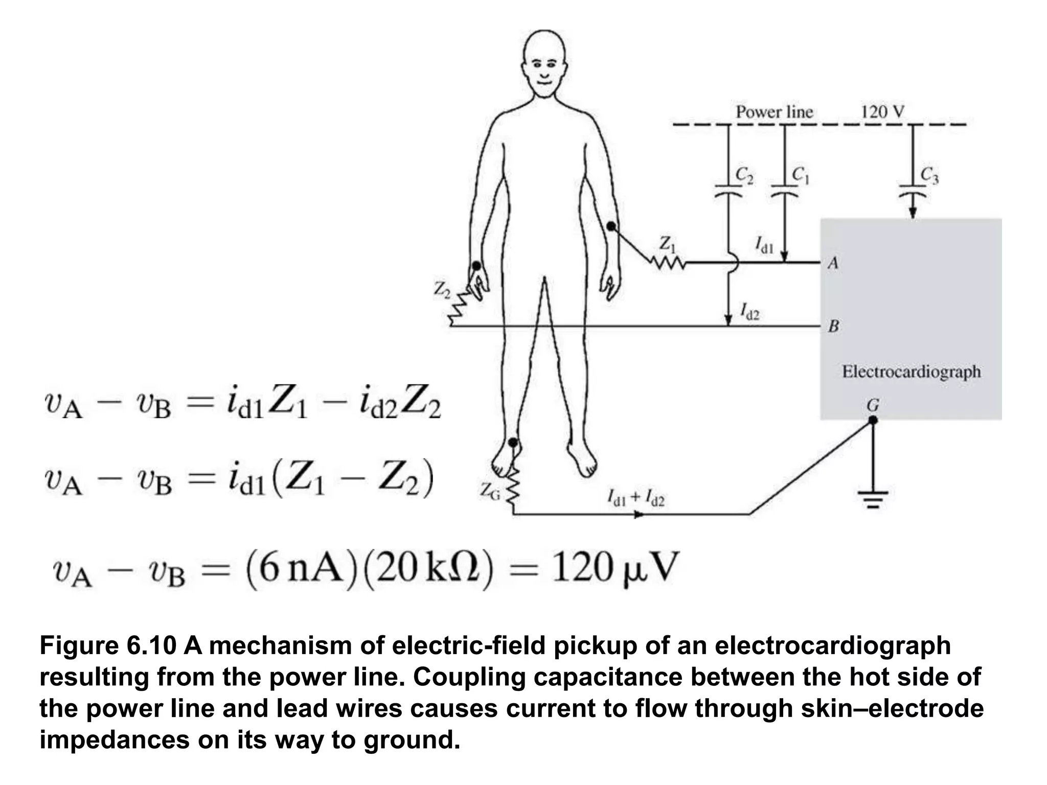 Figure 6.10 A mechanism of electric-field pickup of an electrocardiograph
resulting from the power line. Coupling capacitance between the hot side of
the power line and lead wires causes current to flow through skin–electrode
impedances on its way to ground.
 