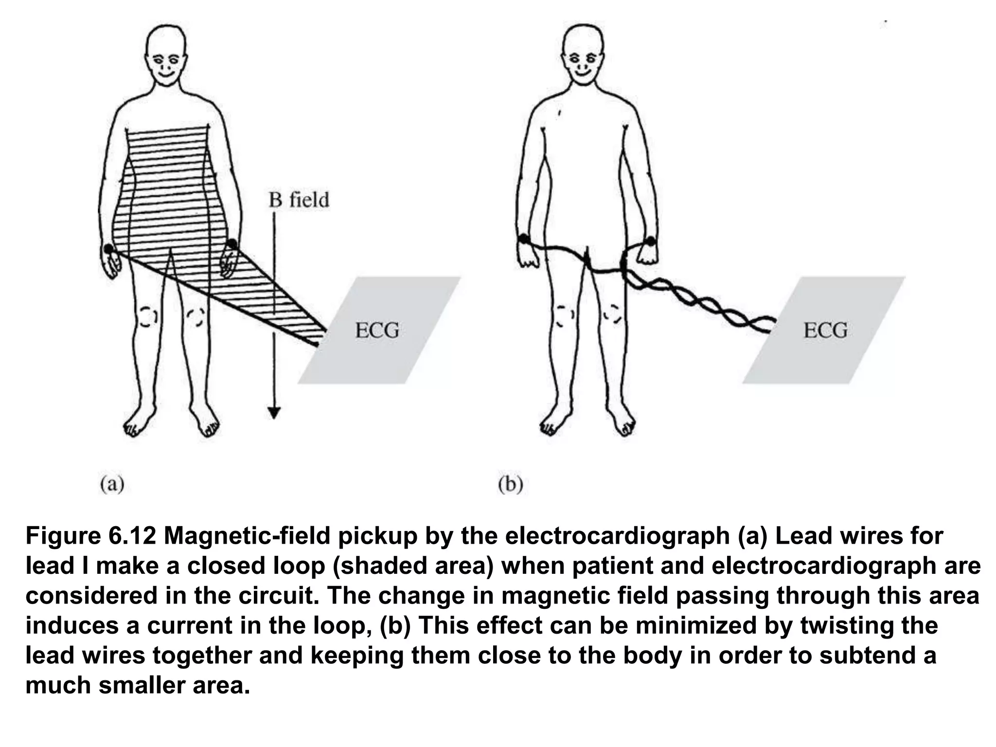 Figure 6.12 Magnetic-field pickup by the electrocardiograph (a) Lead wires for
lead I make a closed loop (shaded area) when patient and electrocardiograph are
considered in the circuit. The change in magnetic field passing through this area
induces a current in the loop, (b) This effect can be minimized by twisting the
lead wires together and keeping them close to the body in order to subtend a
much smaller area.
 