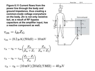 Figure 6.11 Current flows from the
power line through the body and
ground impedance, thus creating a
common-mode voltage everywhere
on the body. Zin is not only resistive
but, as a result of RF bypass
capacitors at the amplifier input, has
a reactive component as well.
 
