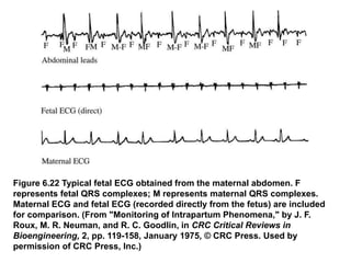 Figure 6.22 Typical fetal ECG obtained from the maternal abdomen. F
represents fetal QRS complexes; M represents maternal QRS complexes.
Maternal ECG and fetal ECG (recorded directly from the fetus) are included
for comparison. (From "Monitoring of Intrapartum Phenomena," by J. F.
Roux, M. R. Neuman, and R. C. Goodlin, in CRC Critical Reviews in
Bioengineering, 2, pp. 119-158, January 1975, © CRC Press. Used by
permission of CRC Press, Inc.)
 