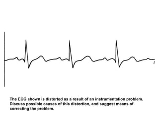 The ECG shown is distorted as a result of an instrumentation problem.
Discuss possible causes of this distortion, and suggest means of
correcting the problem.
 