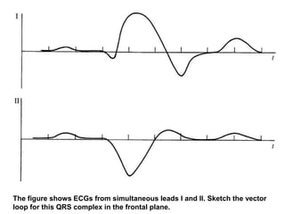 The figure shows ECGs from simultaneous leads I and II. Sketch the vector
loop for this QRS complex in the frontal plane.
 