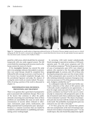pared for a full crown, which should then be cemented
temporarily with zinc oxide–eugenol cement. The full
crown binds the remaining tooth structure much as the
hoops contain the staves of a barrel.
If the incomplete fracture has entered the pulp
and a true pulpalgia indicates that pulpitis is present,
then root canal therapy should be completed ﬁrst,
followed by full coverage to prevent a total fracture. If
the fracture has extended completely through, into
the periodontal ligament and pulp, the chances of
saving the entire tooth are remote indeed. The possi-
bility of saving a portion of the tooth is discussed in
chapter 12.
POSTOPERATIVE PAIN: INCIDENCE,
PREVENTION, AND TREATMENT
There is no question that a good deal of postoperative
pain is associated with endodontic therapy. This is one
of the factors that continues to affect the public
adversely concerning root canal therapy. Some of these
problems are unavoidable, but many are iatral. Apical
overextension of necrotic debris (infected or other-
wise), instruments, paper points, medicaments, and
ﬁlling materials lead to postoperative pain. Apical per-
foration is a common occurrence that can mainly be
avoided by careful attention to establishing and main-
taining correct working length.
274 Endodontics
In surveying 1,204 teeth treated endodontically,
Dutch investigators reported an incidence of 30% post-
operative pain: 7% with severe symptoms and 23%
with moderate symptoms.50 By far the greatest number
of cases of postoperative pain (65%) were related to
patients who reported at the ﬁrst appointment with
preoperative pain. In contrast, only 23% of those who
developed postoperative pain were free of pain initial-
ly. Most postoperative pain occurred on the ﬁrst day
after initiating endodontic treatment. Emergency treat-
ment was necessary in 57% of the patients to relieve the
pain. Analgesics satisﬁed the rest.50
In a subsequent study, the Dutch team further ana-
lyzed a subsection of the cohort of 803 patients with
1,204 teeth, mostly completed in one appointment—1
hour for single canal cases and 2 hours for molars.51 A
positive correlation was found “in the case of a nonvi-
tal pulp in conjunction with preoperative pain on the
day of treatment [and] when a radiolucency larger than
5 mm in diameter is present.” The chance of postoper-
ative pain also increases with the number of root canals
in the tooth. The probability of postoperative pain was
reduced in any case with a vital pulp.51
A US Navy group has also reported that patients
who were asymptomatic at the start of treatment expe-
rienced a low incidence of postoperative pain.52 As one
would expect, they also found that pulpectomy signiﬁ-
Figure 7-8 Radiographs are usually useless in diagnosing undetected fracture. A, The point of fracture (arrow) cannot be seen in a clinical
radiograph. B, After the tooth is extracted and radiographed in a mesial-distal direction, fracture into the pulp (arrow) becomes apparent.
Also note lateral canals. (Courtesy of Dr. Dudley H. Glick.)
 