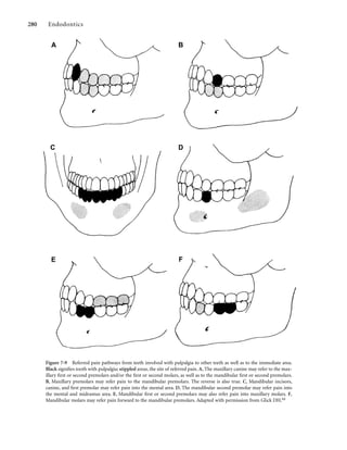 280 Endodontics
Figure 7-9 Referred pain pathways from teeth involved with pulpalgia to other teeth as well as to the immediate area.
Black signiﬁes tooth with pulpalgia; stippled areas, the site of referred pain. A, The maxillary canine may refer to the max-
illary ﬁrst or second premolars and/or the ﬁrst or second molars, as well as to the mandibular ﬁrst or second premolars.
B, Maxillary premolars may refer pain to the mandibular premolars. The reverse is also true. C, Mandibular incisors,
canine, and ﬁrst premolar may refer pain into the mental area. D, The mandibular second premolar may refer pain into
the mental and midramus area. E, Mandibular ﬁrst or second premolars may also refer pain into maxillary molars. F,
Mandibular molars may refer pain forward to the mandibular premolars. Adapted with permission from Glick DH.64
A B
C D
E F
 