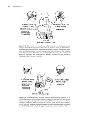 282 Endodontics
Figure 7-11 Pain referred from a maxillary second premolar. Pain was initially experienced
locally in the tooth following noxious stimulation by 10 volts of electricity. Within 5 min-
utes, numbness, fullness in the ear, and muscle stiffness had developed, in addition to steady
pain along the homolateral temporal, zygomatic, and supraorbital areas. The headache
reached its maximum distribution and intensity within 20 minutes after cessation of
toothache. Reproduced with permission from Wolff HG. Headache and other head pain.
New York: Oxford University Press; 1950.
Figure 7-12 Electrical stimulation of a lower ﬁrst molar maintained severe toothache for 10
minutes. Pain was referred into the ear canal and throughout the upper and lower jaws, over the
zygoma and temple, to the top of the ear; a sensation of fullness and ache persisted in the ear.
Numbness and stiffness of the masseter muscle developed. Twenty minutes after stimulation,
severe “lower-half” headache developed throughout the region. Reproduced with permission
from Wolff HG. Headache and other head pain. New York: Oxford University Press; 1950.
 