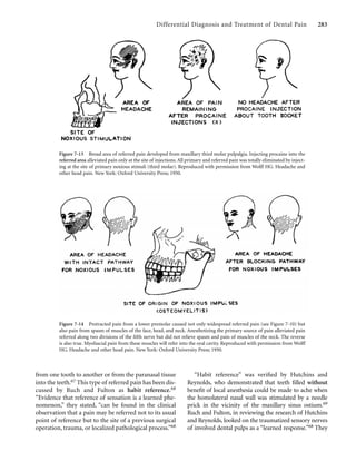 Differential Diagnosis and Treatment of Dental Pain 283
from one tooth to another or from the paranasal tissue
into the teeth.67 This type of referred pain has been dis-
cussed by Ruch and Fulton as habit reference.68
“Evidence that reference of sensation is a learned phe-
nomenon,” they stated, “can be found in the clinical
observation that a pain may be referred not to its usual
point of reference but to the site of a previous surgical
operation, trauma, or localized pathological process.”68
“Habit reference” was veriﬁed by Hutchins and
Reynolds, who demonstrated that teeth ﬁlled without
beneﬁt of local anesthesia could be made to ache when
the homolateral nasal wall was stimulated by a needle
prick in the vicinity of the maxillary sinus ostium.69
Ruch and Fulton, in reviewing the research of Hutchins
and Reynolds, looked on the traumatized sensory nerves
of involved dental pulps as a “learned response.”68 They
Figure 7-13 Broad area of referred pain developed from maxillary third molar pulpalgia. Injecting procaine into the
referred area alleviated pain only at the site of injections.All primary and referred pain was totally eliminated by inject-
ing at the site of primary noxious stimuli (third molar). Reproduced with permission from Wolff HG. Headache and
other head pain. New York: Oxford University Press; 1950.
Figure 7-14 Protracted pain from a lower premolar caused not only widespread referred pain (see Figure 7-10) but
also pain from spasm of muscles of the face, head, and neck. Anesthetizing the primary source of pain alleviated pain
referred along two divisions of the ﬁfth nerve but did not relieve spasm and pain of muscles of the neck. The reverse
is also true. Myofascial pain from these muscles will refer into the oral cavity. Reproduced with permission from Wolff
HG. Headache and other head pain. New York: Oxford University Press; 1950.
 