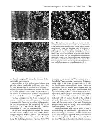 Differential Diagnosis and Treatment of Dental Pain 265
um ﬂuoride precipitate.”26 It may also stimulate the for-
mation of irritation dentin.
Stannous ﬂuoride with carboxylmethylcelluose in a
glycerine gel was found to be signiﬁcantly more effec-
tive than a placebo gel in reducing hypersensitivity,18
and an acidulated sodium ﬂuoride solution decreased
conduction in the tubuli by 24.5%. If sodium ﬂuoride
was applied by iontophoresis, hydraulic conduction in
the dentinal tubules was decreased by 33%.21
Fluoride iontophoresis has been recognized for
years as a consistently successful treatment for dentinal
hypersensitivity. Gangerosa is credited with populariz-
ing this treatment when he introduced the Electro
Applicator. The Desensitron (Parkell Products,
Farmingdale, N.Y.) has also proved effective.
To use these battery-powered devices, the patient
holds the positive electrode in his hand and the dentist,
using the negative electrode, applies a 2% solution of
sodium ﬂuoride to the sensitive areas of the teeth.
Using this technique, Simmons reported 94 to 99%
reduction in hypersensitivity.28 According to a report
from India,29 a comparative evaluation of the desensi-
tizing effects of the topical application of 33.3% sodi-
um ﬂuoride paste, of iontophoresis with a 1% solution
of sodium ﬂuoride, and of iontophoresis with the
patient’s own saliva was made. Iontophoresis with
sodium ﬂuoride produced immediate relief after one
application, whereas topical application required two
to three applications. The authors concluded that “ion-
tophoresis with 1% sodium ﬂuoride is the method of
choice for the treatment of hypersensitive dentin, as it
meets all the requirements of an ideal desensitizing
agent except permanency of effect, which requires fur-
ther investigation” (Table 7-1).29
Gangerosa reported very similar results as well as
recommending the iontophoretic application of the
ﬂuoride in a tray to desensitize a number of teeth.30–33
Carlo and colleagues reported 100% desensitization
after two iontophoretic ﬂuoride treatments 73.9% of
the time.34 Brough et al., on the other hand, found one
Figure 7-6 A, Smear layer–covered dentin treated with 3%
monopotassium-monohydrogen oxalate for 30 seconds (original
×1,000 magniﬁcation). Enlarged inset (×10,000 original magniﬁ-
cation) reveals a crack over the tubule. Much of the surface is
angular crystals of calcium oxalate. (Courtesty of David H.
Pashley.) B, Smear layer treated with neutral 30% dipotassium
oxalate. Note large crystals growing out of the smear layer. C,
Surface of B treated with 3% monopotassium-monohydrogen
oxalate, pH 2.0, acid etches the smear layer away but reacts with
calcium from tubular ﬂuid to release a host of ﬁner crystals effec-
tively plugging the tubules. B and C reproduced with permission
from Pashley DH, Galloway SE. Arch Oral Biol 1985;30:731.
A B
C
 