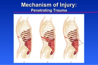 Mechanism of Injury: Penetrating Trauma 