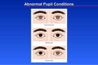 Abnormal Pupil Conditions 