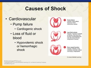 Causes of Shock
• Cardiovascular
− Pump failure
• Cardiogenic shock
− Loss of fluid or
blood
• Hypovolemic shock
or hemorrhagic
shock
© Jones & Bartlett Learning.
 