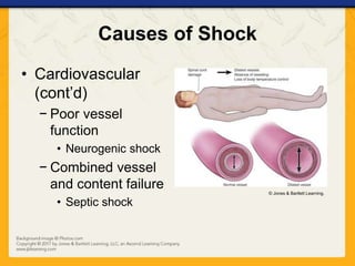 Causes of Shock
• Cardiovascular
(cont’d)
− Poor vessel
function
• Neurogenic shock
− Combined vessel
and content failure
• Septic shock
© Jones & Bartlett Learning.
 