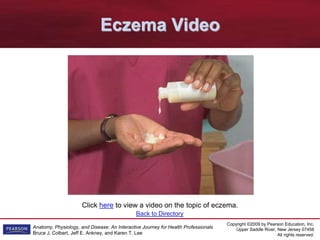 Copyright ©2009 by Pearson Education, Inc.
Upper Saddle River, New Jersey 07458
All rights reserved.
Anatomy, Physiology, and Disease: An Interactive Journey for Health Professionals
Bruce J. Colbert, Jeff E. Ankney, and Karen T. Lee
Click here to view a video on the topic of eczema.
Eczema Video
Back to Directory
 