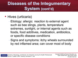 Copyright ©2009 by Pearson Education, Inc.
Upper Saddle River, New Jersey 07458
All rights reserved.
Anatomy, Physiology, and Disease: An Interactive Journey for Health Professionals
Bruce J. Colbert, Jeff E. Ankney, and Karen T. Lee
Diseases of the Integumentary
System (cont’d)
• Hives (urticaria)
–Etiology: allergic reaction to external agent
such as bee stings, plants, temperature
extremes, sunlight, or internal agents such as
foods, food additives, medication, antibiotics,
or specific disease conditions
–Signs and symptoms: itchy wheals surrounded
by red inflamed area; can cover most of body
 