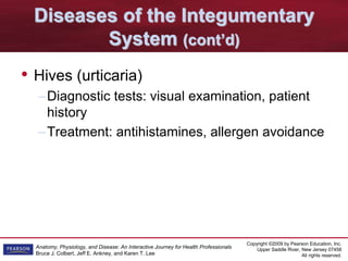 Copyright ©2009 by Pearson Education, Inc.
Upper Saddle River, New Jersey 07458
All rights reserved.
Anatomy, Physiology, and Disease: An Interactive Journey for Health Professionals
Bruce J. Colbert, Jeff E. Ankney, and Karen T. Lee
Diseases of the Integumentary
System (cont’d)
• Hives (urticaria)
–Diagnostic tests: visual examination, patient
history
–Treatment: antihistamines, allergen avoidance
 