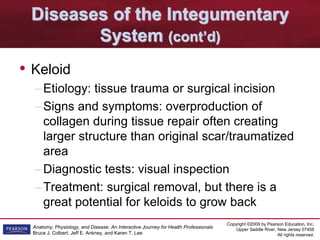 Copyright ©2009 by Pearson Education, Inc.
Upper Saddle River, New Jersey 07458
All rights reserved.
Anatomy, Physiology, and Disease: An Interactive Journey for Health Professionals
Bruce J. Colbert, Jeff E. Ankney, and Karen T. Lee
Diseases of the Integumentary
System (cont’d)
• Keloid
–Etiology: tissue trauma or surgical incision
–Signs and symptoms: overproduction of
collagen during tissue repair often creating
larger structure than original scar/traumatized
area
–Diagnostic tests: visual inspection
–Treatment: surgical removal, but there is a
great potential for keloids to grow back
 