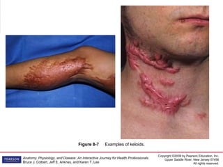 Copyright ©2009 by Pearson Education, Inc.
Upper Saddle River, New Jersey 07458
All rights reserved.
Anatomy, Physiology, and Disease: An Interactive Journey for Health Professionals
Bruce J. Colbert, Jeff E. Ankney, and Karen T. Lee
Figure 8-7 Examples of keloids.
 