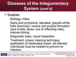 Copyright ©2009 by Pearson Education, Inc.
Upper Saddle River, New Jersey 07458
All rights reserved.
Anatomy, Physiology, and Disease: An Interactive Journey for Health Professionals
Bruce J. Colbert, Jeff E. Ankney, and Karen T. Lee
Diseases of the Integumentary
System (cont’d)
• Scabies
–Etiology: mites
–Signs and symptoms: elevated, grayish-white
lines (burrows), vesicle and pustule formation
(due to bite, feces, ova of offending mite),
intense itching
–Diagnostic tests: visual inspection
–Treatment: proper cleaning technique,
application of medicated cream, all infected
individuals must be treated to prevent re-
infection
 