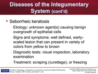 Copyright ©2009 by Pearson Education, Inc.
Upper Saddle River, New Jersey 07458
All rights reserved.
Anatomy, Physiology, and Disease: An Interactive Journey for Health Professionals
Bruce J. Colbert, Jeff E. Ankney, and Karen T. Lee
Diseases of the Integumentary
System (cont’d)
• Seborrheic keratosis
–Etiology: unknown agent(s) causing benign
overgrowth of epithelial cells
–Signs and symptoms: well defined, warty-
scaled lesion that can present in variety of
colors from yellow to brown
–Diagnostic tests: visual inspection, laboratory
examination
–Treatment: scraping (curettage), or freezing
 