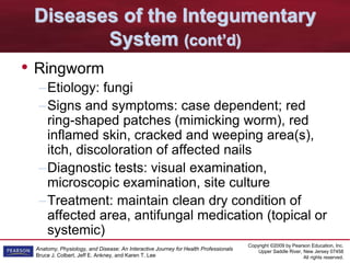 Copyright ©2009 by Pearson Education, Inc.
Upper Saddle River, New Jersey 07458
All rights reserved.
Anatomy, Physiology, and Disease: An Interactive Journey for Health Professionals
Bruce J. Colbert, Jeff E. Ankney, and Karen T. Lee
Diseases of the Integumentary
System (cont’d)
• Ringworm
–Etiology: fungi
–Signs and symptoms: case dependent; red
ring-shaped patches (mimicking worm), red
inflamed skin, cracked and weeping area(s),
itch, discoloration of affected nails
–Diagnostic tests: visual examination,
microscopic examination, site culture
–Treatment: maintain clean dry condition of
affected area, antifungal medication (topical or
systemic)
 