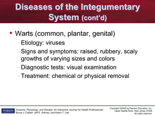 Copyright ©2009 by Pearson Education, Inc.
Upper Saddle River, New Jersey 07458
All rights reserved.
Anatomy, Physiology, and Disease: An Interactive Journey for Health Professionals
Bruce J. Colbert, Jeff E. Ankney, and Karen T. Lee
Diseases of the Integumentary
System (cont’d)
• Warts (common, plantar, genital)
–Etiology: viruses
–Signs and symptoms: raised, rubbery, scaly
growths of varying sizes and colors
–Diagnostic tests: visual examination
–Treatment: chemical or physical removal
 