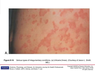 Copyright ©2009 by Pearson Education, Inc.
Upper Saddle River, New Jersey 07458
All rights reserved.
Anatomy, Physiology, and Disease: An Interactive Journey for Health Professionals
Bruce J. Colbert, Jeff E. Ankney, and Karen T. Lee
Figure 8-14 Various types of integumentary conditions. (a) Urticaria (hives). (Courtesy of Jason L. Smith,
MD.)
 