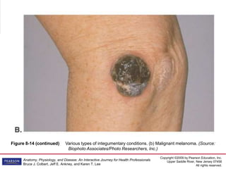 Copyright ©2009 by Pearson Education, Inc.
Upper Saddle River, New Jersey 07458
All rights reserved.
Anatomy, Physiology, and Disease: An Interactive Journey for Health Professionals
Bruce J. Colbert, Jeff E. Ankney, and Karen T. Lee
Figure 8-14 (continued) Various types of integumentary conditions. (b) Malignant melanoma. (Source:
Biophoto Associates/Photo Researchers, Inc.)
 