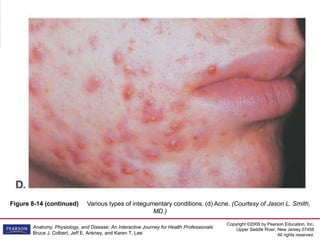 Copyright ©2009 by Pearson Education, Inc.
Upper Saddle River, New Jersey 07458
All rights reserved.
Anatomy, Physiology, and Disease: An Interactive Journey for Health Professionals
Bruce J. Colbert, Jeff E. Ankney, and Karen T. Lee
Figure 8-14 (continued) Various types of integumentary conditions. (d) Acne. (Courtesy of Jason L. Smith,
MD.)
 