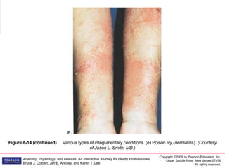 Copyright ©2009 by Pearson Education, Inc.
Upper Saddle River, New Jersey 07458
All rights reserved.
Anatomy, Physiology, and Disease: An Interactive Journey for Health Professionals
Bruce J. Colbert, Jeff E. Ankney, and Karen T. Lee
Figure 8-14 (continued) Various types of integumentary conditions. (e) Poison ivy (dermatitis). (Courtesy
of Jason L. Smith, MD.)
 