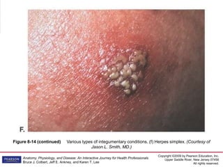 Copyright ©2009 by Pearson Education, Inc.
Upper Saddle River, New Jersey 07458
All rights reserved.
Anatomy, Physiology, and Disease: An Interactive Journey for Health Professionals
Bruce J. Colbert, Jeff E. Ankney, and Karen T. Lee
Figure 8-14 (continued) Various types of integumentary conditions. (f) Herpes simplex. (Courtesy of
Jason L. Smith, MD.)
 