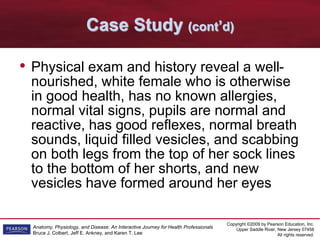 Copyright ©2009 by Pearson Education, Inc.
Upper Saddle River, New Jersey 07458
All rights reserved.
Anatomy, Physiology, and Disease: An Interactive Journey for Health Professionals
Bruce J. Colbert, Jeff E. Ankney, and Karen T. Lee
Case Study (cont’d)
• Physical exam and history reveal a well-
nourished, white female who is otherwise
in good health, has no known allergies,
normal vital signs, pupils are normal and
reactive, has good reflexes, normal breath
sounds, liquid filled vesicles, and scabbing
on both legs from the top of her sock lines
to the bottom of her shorts, and new
vesicles have formed around her eyes
 