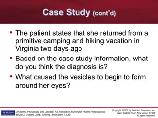 Copyright ©2009 by Pearson Education, Inc.
Upper Saddle River, New Jersey 07458
All rights reserved.
Anatomy, Physiology, and Disease: An Interactive Journey for Health Professionals
Bruce J. Colbert, Jeff E. Ankney, and Karen T. Lee
Case Study (cont’d)
• The patient states that she returned from a
primitive camping and hiking vacation in
Virginia two days ago
• Based on the case study information, what
do you think the diagnosis is?
• What caused the vesicles to begin to form
around her eyes?
 