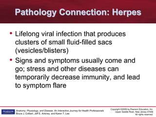 Copyright ©2009 by Pearson Education, Inc.
Upper Saddle River, New Jersey 07458
All rights reserved.
Anatomy, Physiology, and Disease: An Interactive Journey for Health Professionals
Bruce J. Colbert, Jeff E. Ankney, and Karen T. Lee
Pathology Connection: Herpes
• Lifelong viral infection that produces
clusters of small fluid-filled sacs
(vesicles/blisters)
• Signs and symptoms usually come and
go; stress and other diseases can
temporarily decrease immunity, and lead
to symptom flare
 