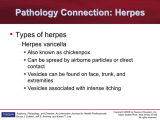 Copyright ©2009 by Pearson Education, Inc.
Upper Saddle River, New Jersey 07458
All rights reserved.
Anatomy, Physiology, and Disease: An Interactive Journey for Health Professionals
Bruce J. Colbert, Jeff E. Ankney, and Karen T. Lee
Pathology Connection: Herpes
• Types of herpes
–Herpes varicella
 Also known as chickenpox
 Can be spread by airborne particles or direct
contact
 Vesicles can be found on face, trunk, and
extremities
 Vesicles associated with intense itching
 